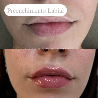 preenchimento-labial-em-niteroi