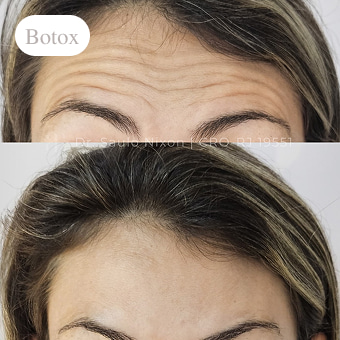 procedimento-estetico-clinica-asha