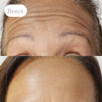 procedimento-estetico2-clinica-asha