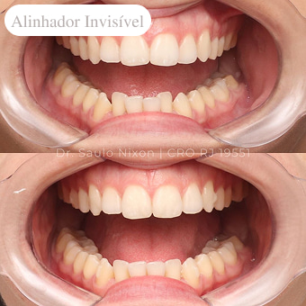 antes-e-depois-alinhador-invisível-em-niterói