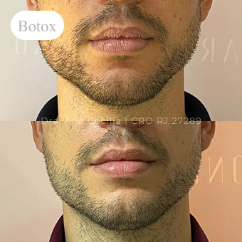 antes-e-depois-botox-em-niterói