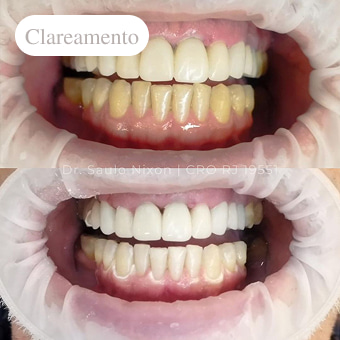 antes-e-depois-clareamento-em-niterói