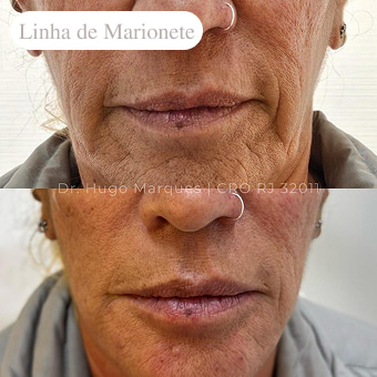 antes-e-depois-linha-de-marionete-em-niterói