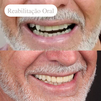antes-e-depois-reabilitação-oral-em-niterói